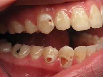 Tooth-Decay
