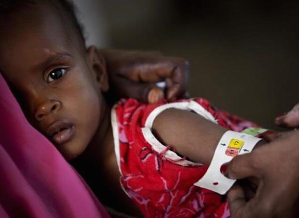 malnutrition (1)