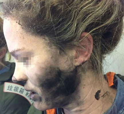 Headphone-battery-explosion-victim