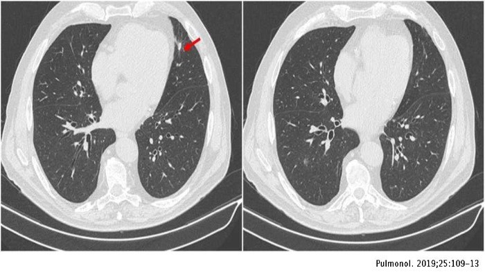 Giant Cell Arteritis_ Difficult to diagnose, eminently treatable