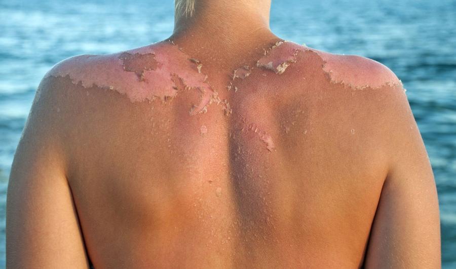 Sun burn