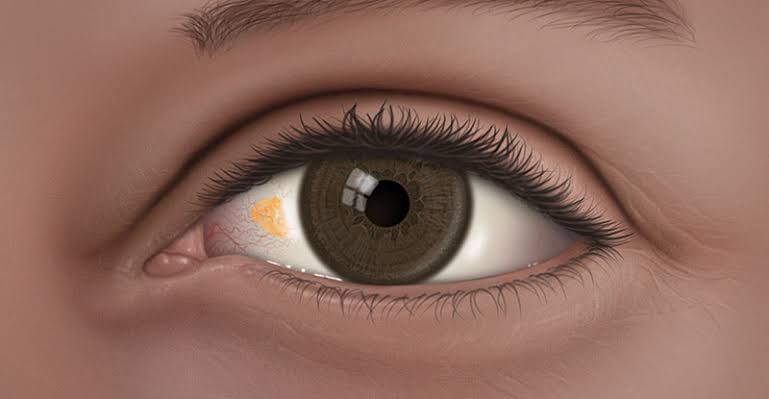 eye treatment