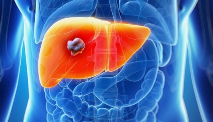 Liver cancer high amidst ignorance in Nigeria, expert