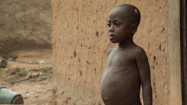 Malnutrition