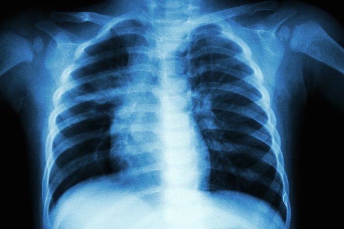Tuberculosis