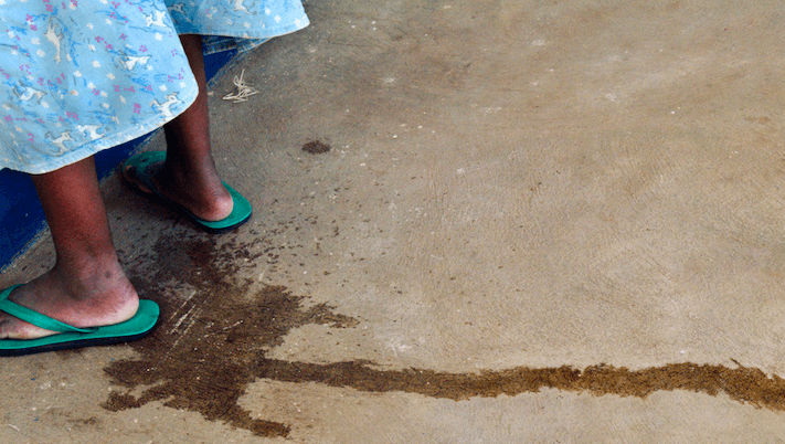 Obstetric fistula