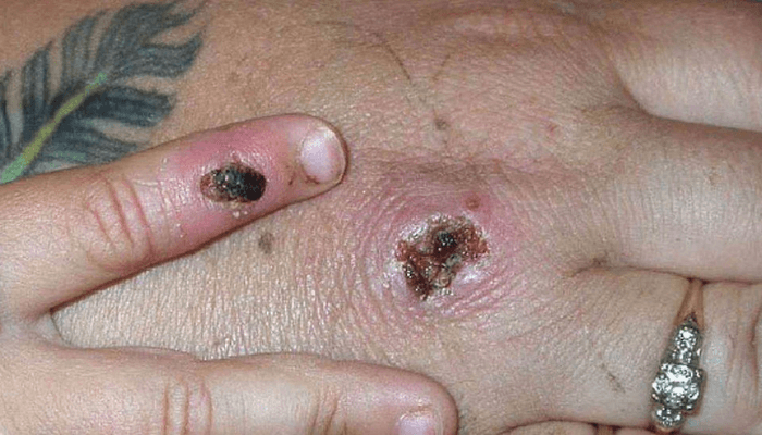 Monkeypox: UK warns against sex as cases pass 100