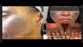 INVESTIGATION: Deadly Trade (I): Fair skin at the cost of people’s health (Video)