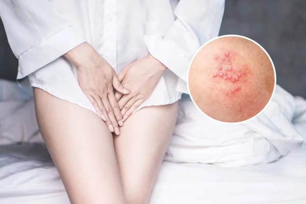 Genital herpes