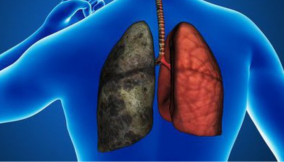 We partner IHV to reduce prevalence of tuberculosis in Ogun – OGSG