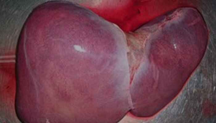 Medical experts raise alarm over dangers of self-medication on liver health